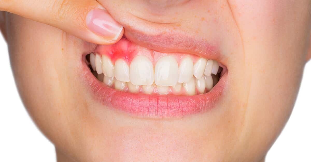 Gum Disease Treatment