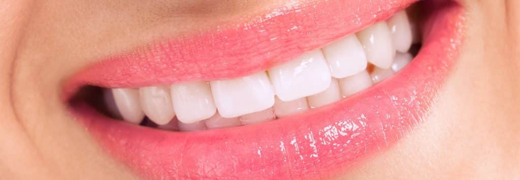 After Philips Zoom whitening at Royal Oak Dental, Oakville