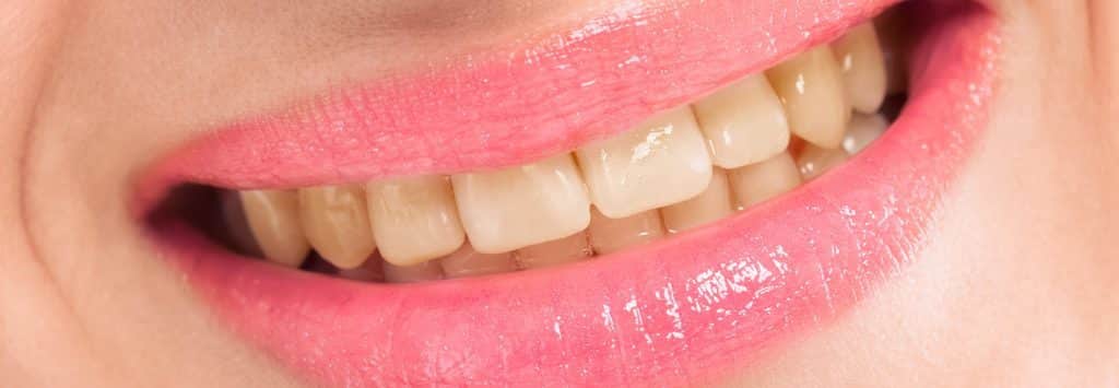 Before teeth whitening