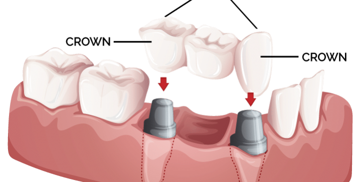 crowns-and-bridges