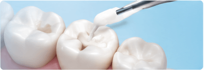 Dental Fillings & Bonding