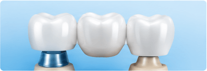 Dental Crowns & Bridges