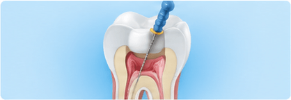 Root Canal Treatment