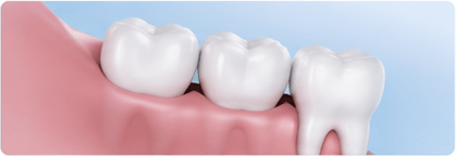 Wisdom Teeth Removal & Tooth Extractions