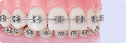 Braces & Orthodontic Treatment
