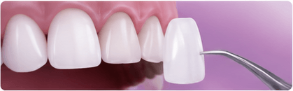 Porcelain Veneers & Smile Makeovers