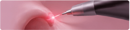 Laser Dentistry & Frenectomy