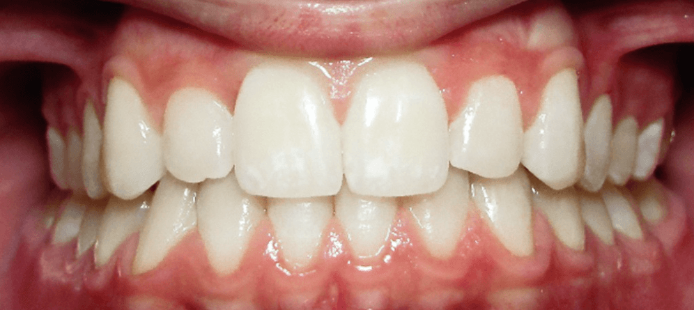 Invisalign before and after at Royal Oak Dental, Oakville after