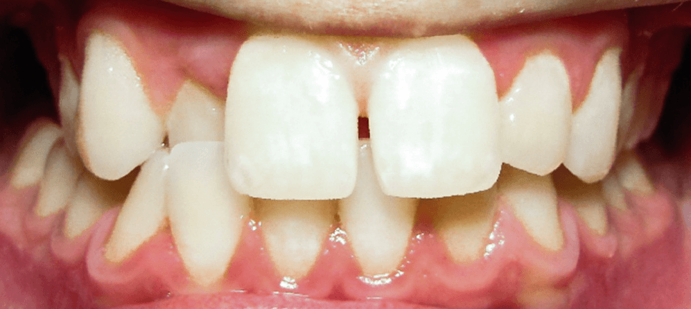 Invisalign before and after at Royal Oak Dental, Oakville before