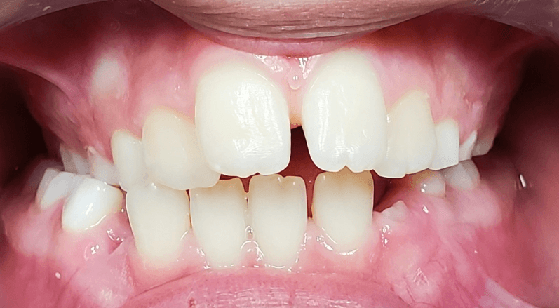 Invisalign before and after at Royal Oak Dental, Oakville before