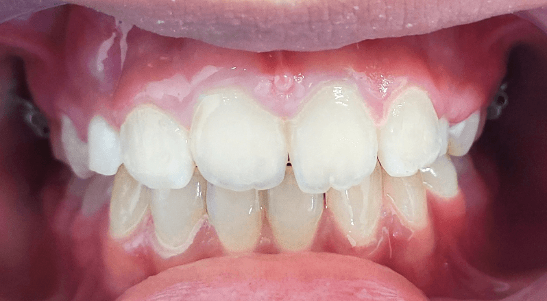 Invisalign before and after at Royal Oak Dental, Oakville after