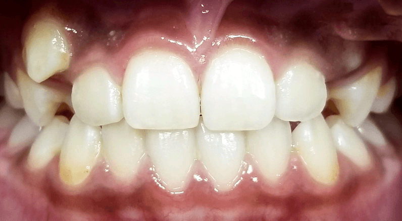 Invisalign before and after at Royal Oak Dental, Oakville before