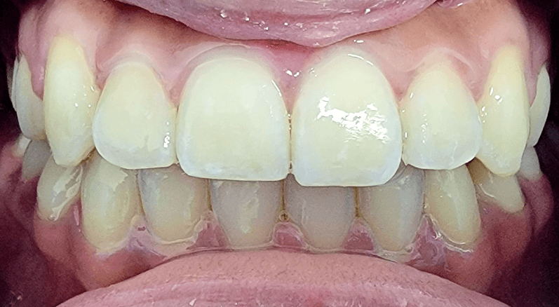 Invisalign before and after at Royal Oak Dental, Oakville after